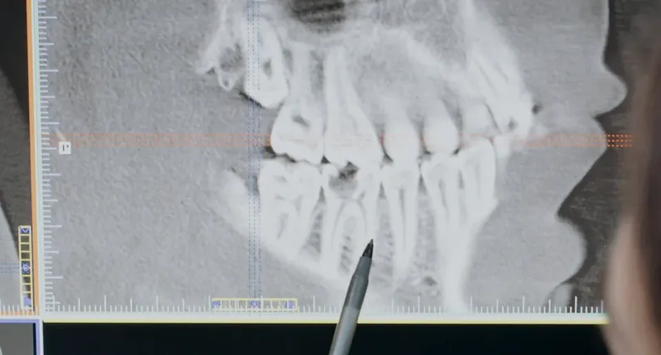 Radiografía volumétrica (CBCT) de una arcada dental en la pantalla de planificación