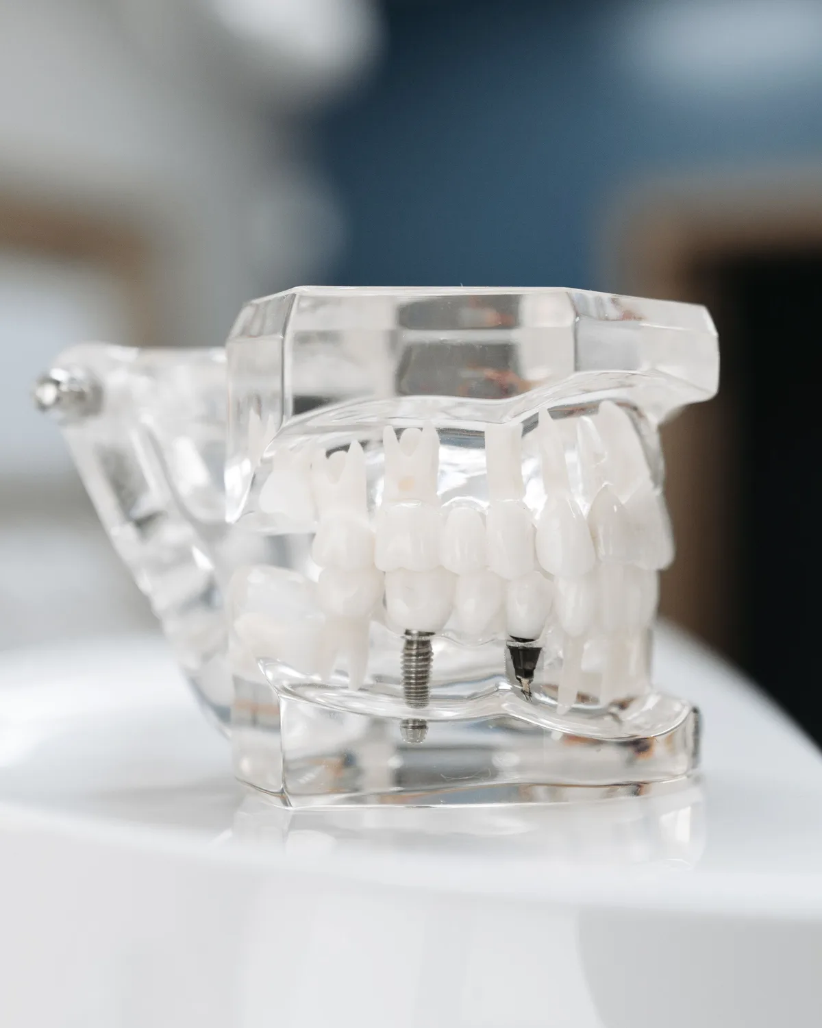 Modelo transparente que muestra la colocación de un implante dental